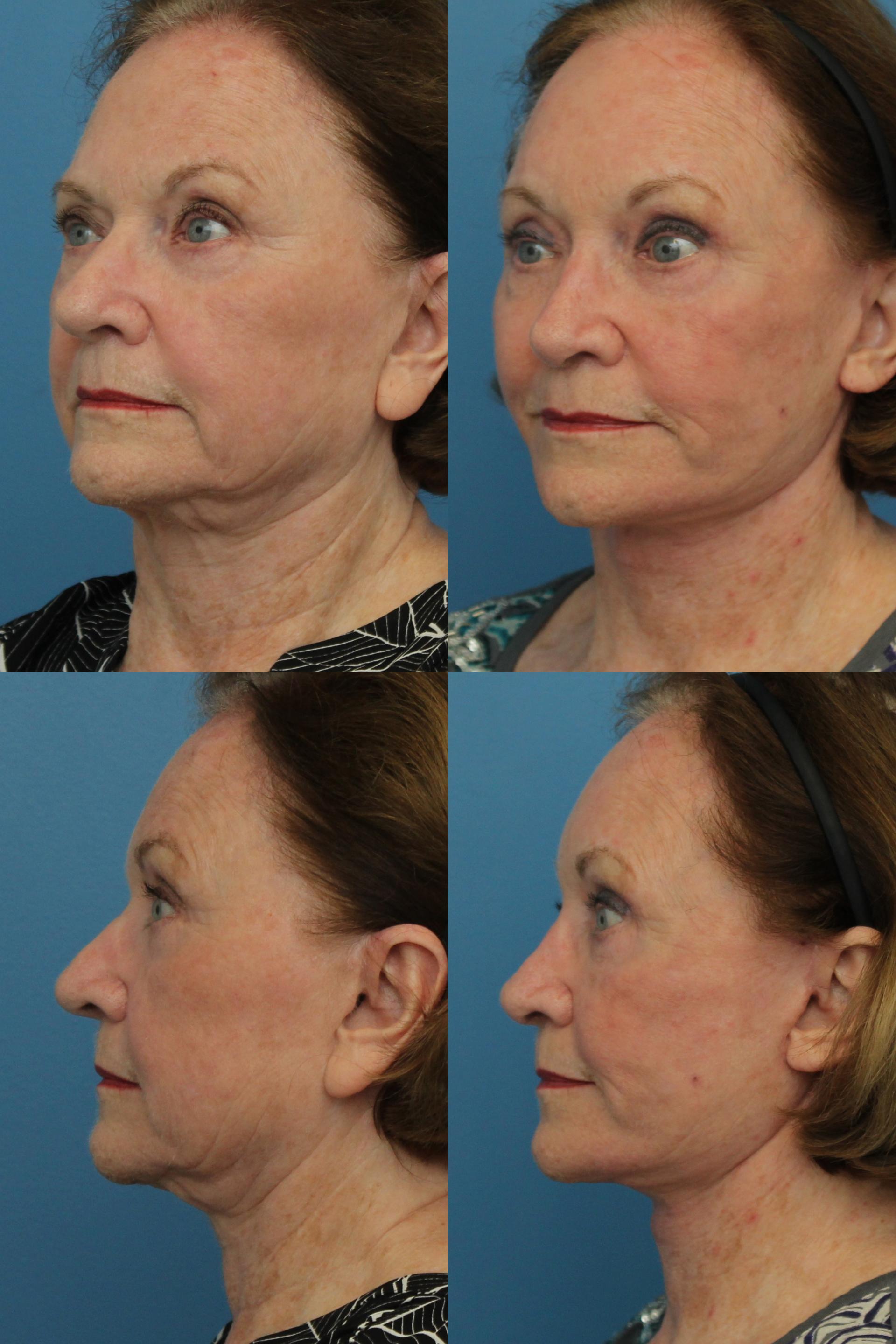 Ranch & Coast Plastic Surgery | Dr. Paul Chasan result — Del Mar, CA