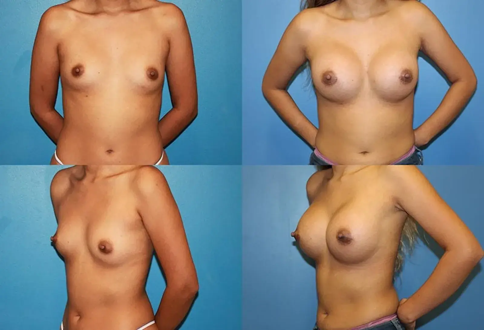 Ranch & Coast Plastic Surgery | Dr. Paul Chasan breast augmentation result — Del Mar, CA