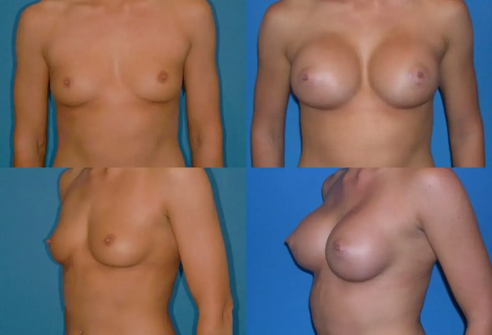 Ranch & Coast Plastic Surgery | Dr. Paul Chasan breast augmentation result — Del Mar, CA