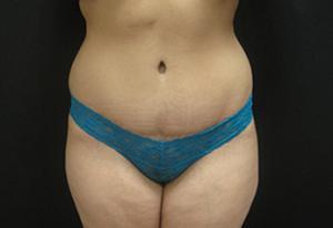 Cangello Plastic Surgery tummy tuck after — New York, NY