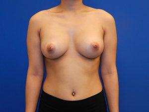 Cangello Plastic Surgery breast augmentation after — New York, NY