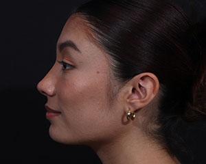Cangello Plastic Surgery rhinoplasty after — New York, NY
