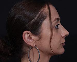 Cangello Plastic Surgery rhinoplasty after — New York, NY