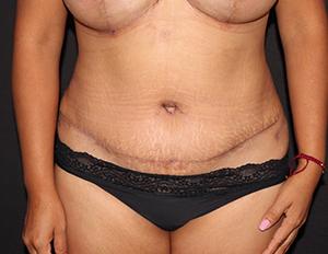Cangello Plastic Surgery tummy tuck after — New York, NY