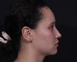 Cangello Plastic Surgery rhinoplasty after — New York, NY
