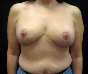 Breast Reduction after at Cangello Plastic Surgery in New York, NY