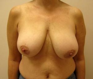 Breast Reduction before at Cangello Plastic Surgery in New York, NY