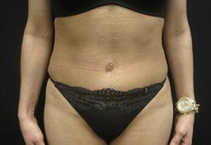 Cangello Plastic Surgery tummy tuck after — New York, NY