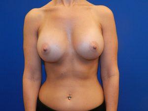 Cangello Plastic Surgery breast augmentation after — New York, NY