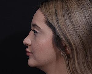 Cangello Plastic Surgery rhinoplasty after — New York, NY