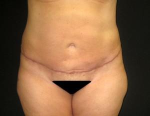 Cangello Plastic Surgery tummy tuck after — New York, NY