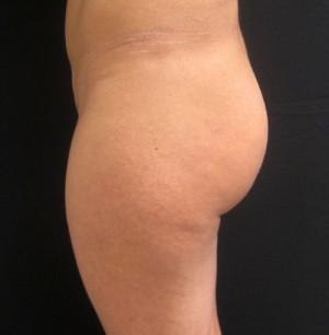 Brazilian Butt Lift after at Cangello Plastic Surgery in New York, NY
