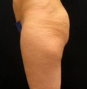 Brazilian Butt Lift before at Cangello Plastic Surgery in New York, NY