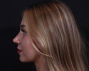 Cangello Plastic Surgery rhinoplasty after — New York, NY