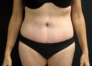 Tummy Tuck after at Cangello Plastic Surgery in New York, NY