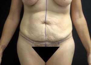 Tummy Tuck before at Cangello Plastic Surgery in New York, NY