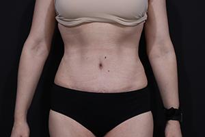 Cangello Plastic Surgery tummy tuck after — New York, NY