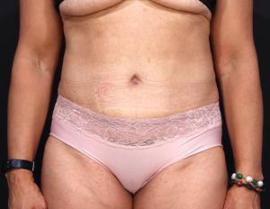 Cangello Plastic Surgery tummy tuck after — New York, NY