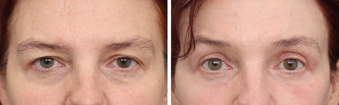 Gold Coast Plastic Surgery brow lift result — Chicago, IL
