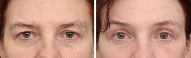 Brow Lift result at Gold Coast Plastic Surgery in Chicago, IL