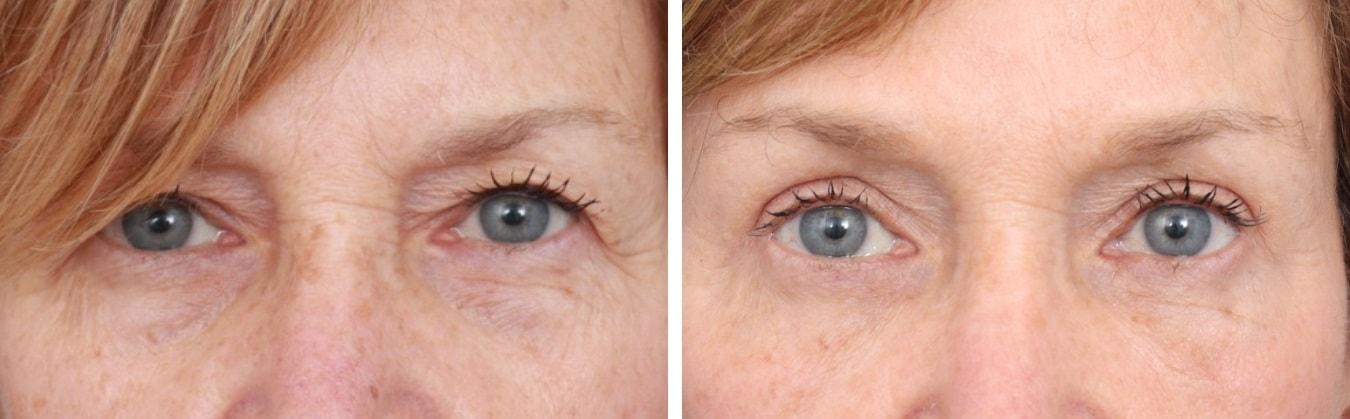 Gold Coast Plastic Surgery brow lift result — Chicago, IL