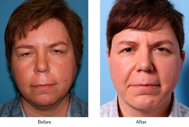 Chin Implant result at Gold Coast Plastic Surgery in Chicago, IL
