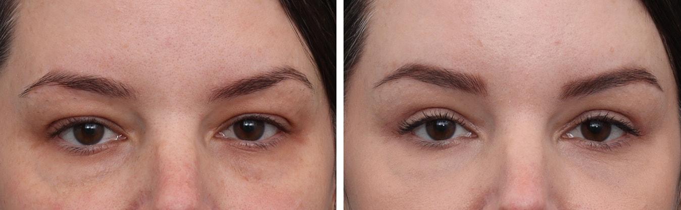 Gold Coast Plastic Surgery brow lift result — Chicago, IL