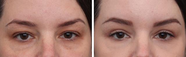 Brow Lift result at Gold Coast Plastic Surgery in Chicago, IL