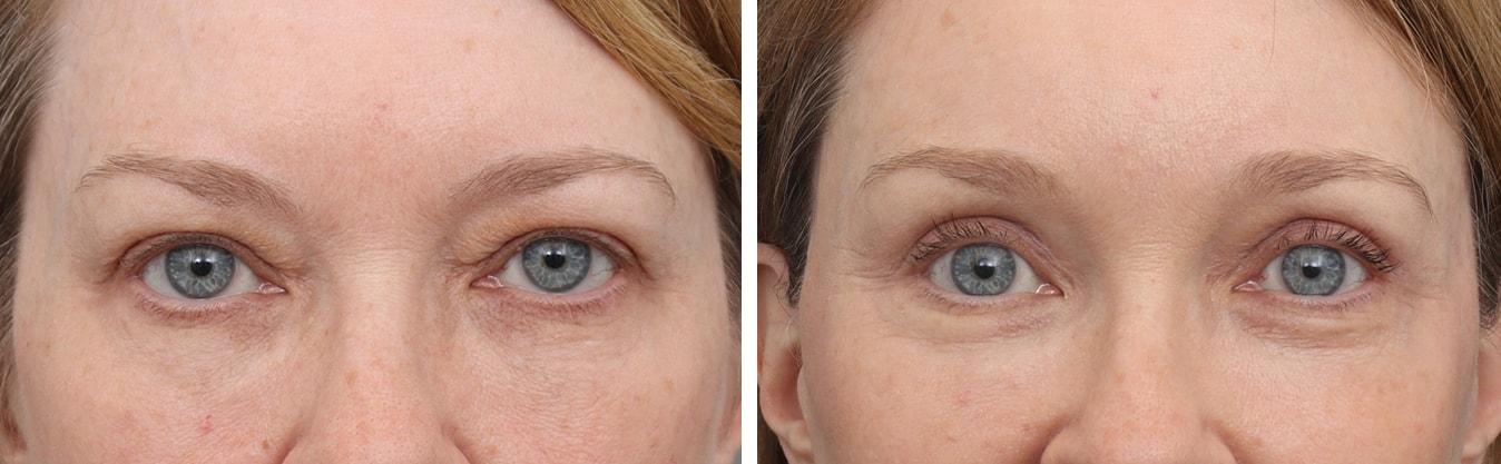 Gold Coast Plastic Surgery brow lift result — Chicago, IL