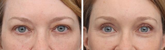 Brow Lift result at Gold Coast Plastic Surgery in Chicago, IL