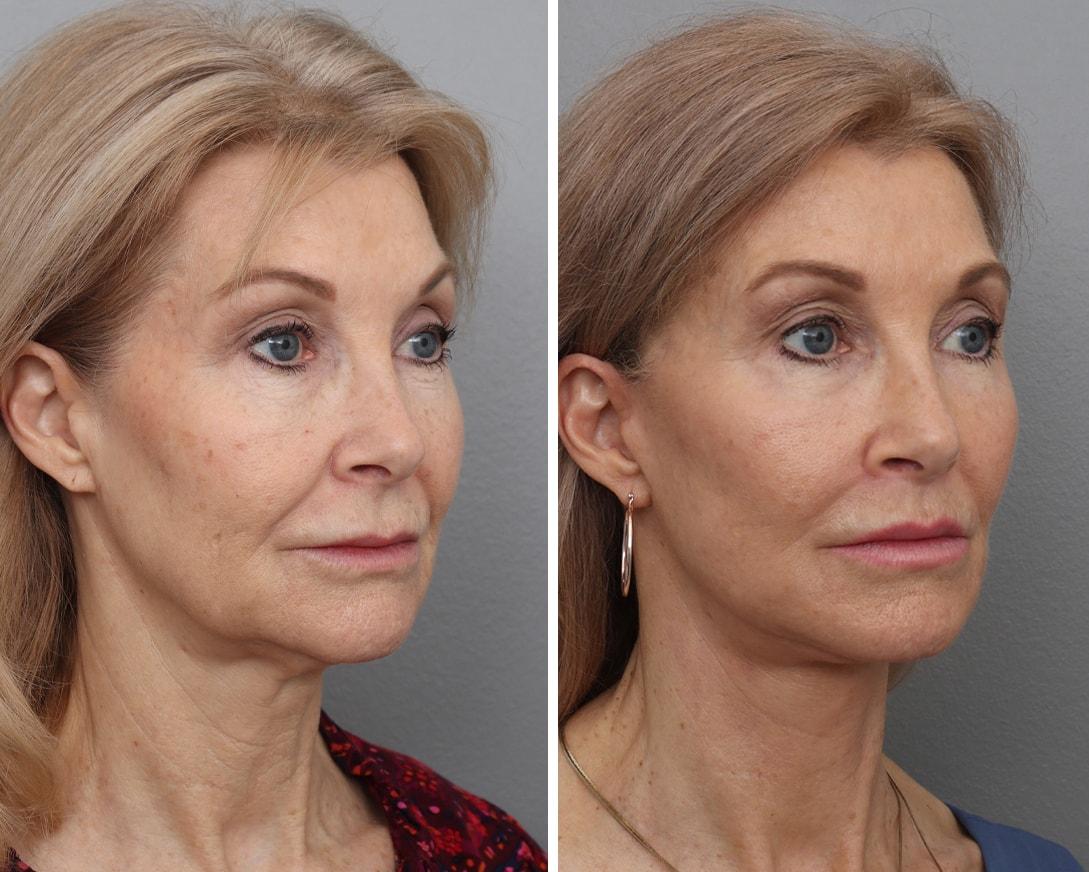 Gold Coast Plastic Surgery facelift result — Chicago, IL
