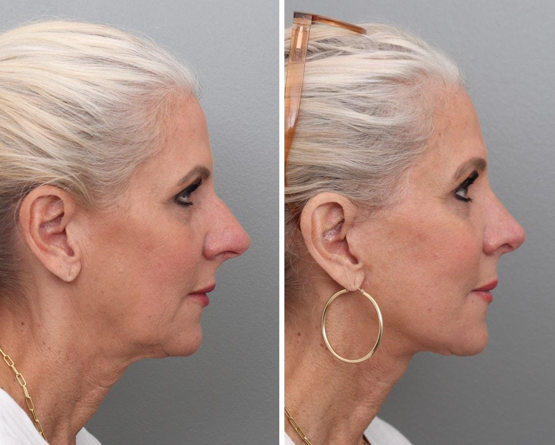 Gold Coast Plastic Surgery facelift result — Chicago, IL