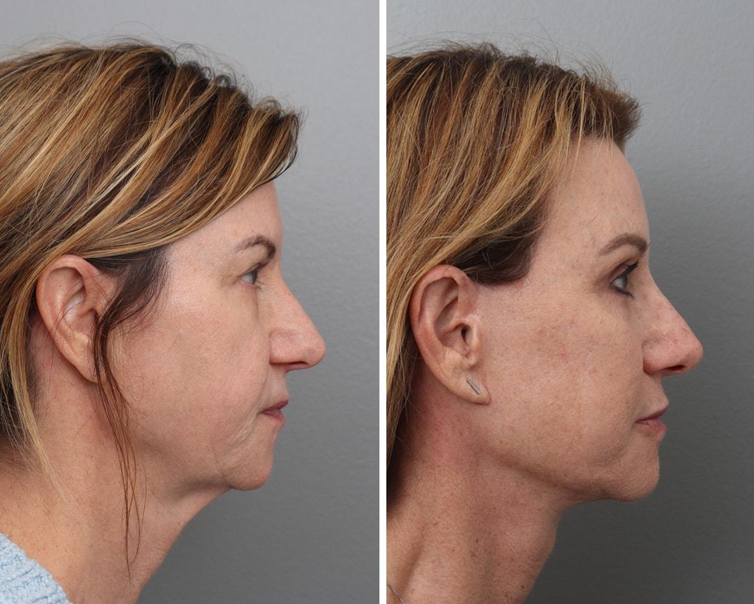 Gold Coast Plastic Surgery facelift result — Chicago, IL