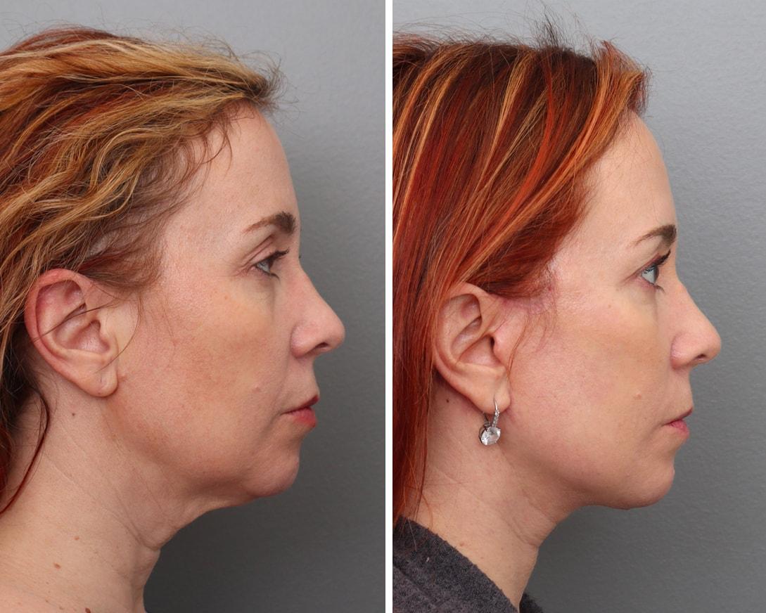 Gold Coast Plastic Surgery facelift result — Chicago, IL