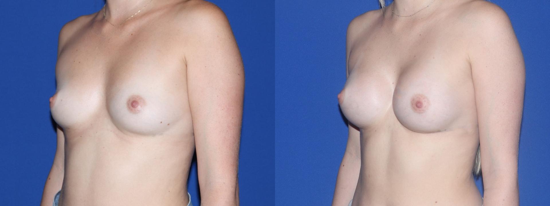 Gold Coast Plastic Surgery breast augmentation result — Chicago, IL