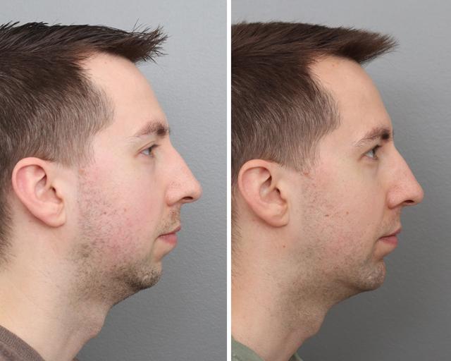 Chin Implant result at Gold Coast Plastic Surgery in Chicago, IL