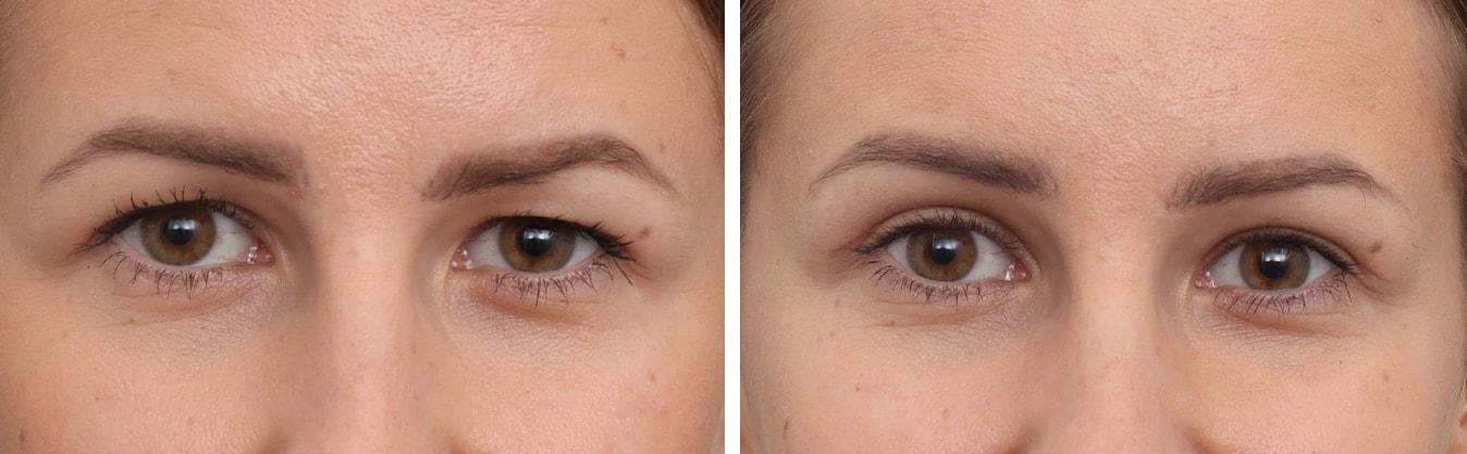 Gold Coast Plastic Surgery brow lift result — Chicago, IL