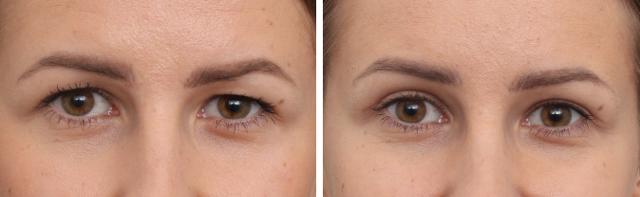 Brow Lift result at Gold Coast Plastic Surgery in Chicago, IL