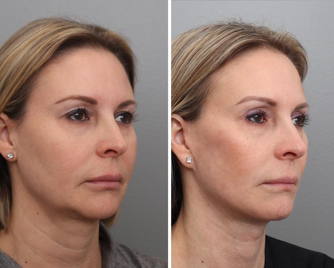 Gold Coast Plastic Surgery facelift result — Chicago, IL