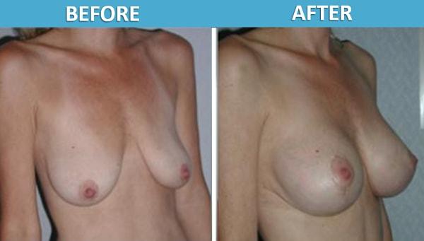 Breast Lift result at Center for Cosmetic Surgery: Sassan Alavi, MD in San Diego, CA