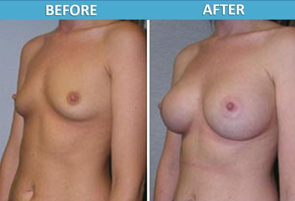 Fat Transfer Breast Augmentation result at Center for Cosmetic Surgery: Sassan Alavi, MD in San Diego, CA