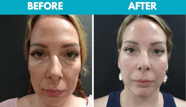 Center for Cosmetic Surgery: Sassan Alavi, MD facelift result — San Diego, CA