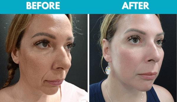Center for Cosmetic Surgery: Sassan Alavi, MD facelift result — San Diego, CA