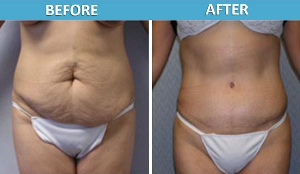 Mini Tummy Tuck result at Center for Cosmetic Surgery: Sassan Alavi, MD in San Diego, CA
