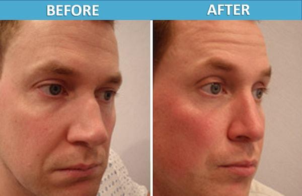 Functional Rhinoplasty result at Center for Cosmetic Surgery: Sassan Alavi, MD in San Diego, CA