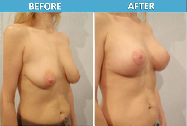 Breast Lift result at Center for Cosmetic Surgery: Sassan Alavi, MD in San Diego, CA
