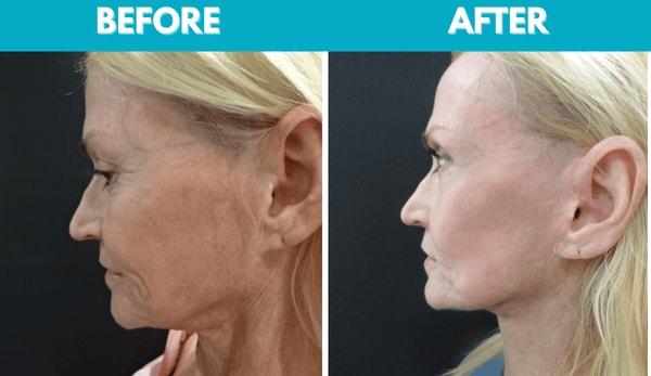 Facelift result at Center for Cosmetic Surgery: Sassan Alavi, MD in San Diego, CA