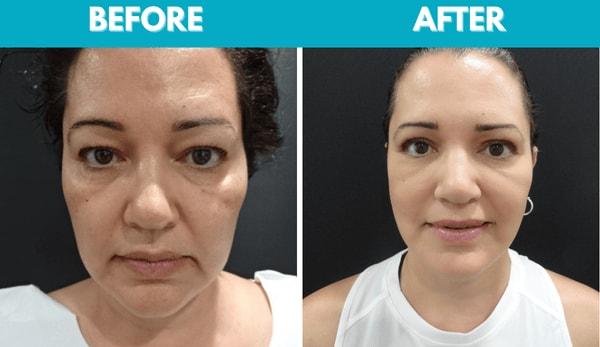 Center for Cosmetic Surgery: Sassan Alavi, MD facelift result — San Diego, CA