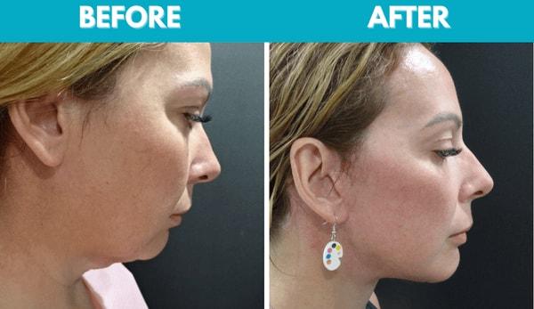 Center for Cosmetic Surgery: Sassan Alavi, MD facelift result — San Diego, CA