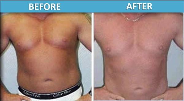 Liposuction result at Center for Cosmetic Surgery: Sassan Alavi, MD in San Diego, CA